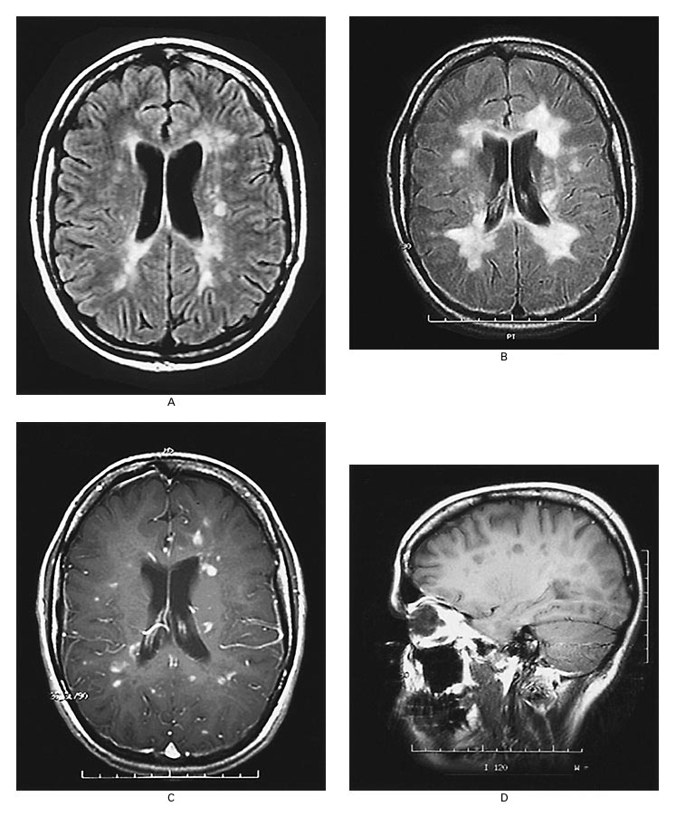 Ms On Mri