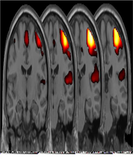 Activation of motor cortex - left finger tapping